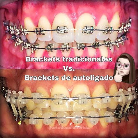 diferencia entre brackets y autoligables